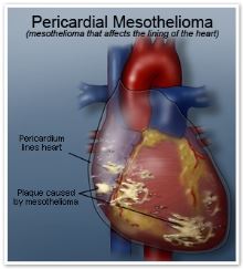 Pericardial Mesothelioma